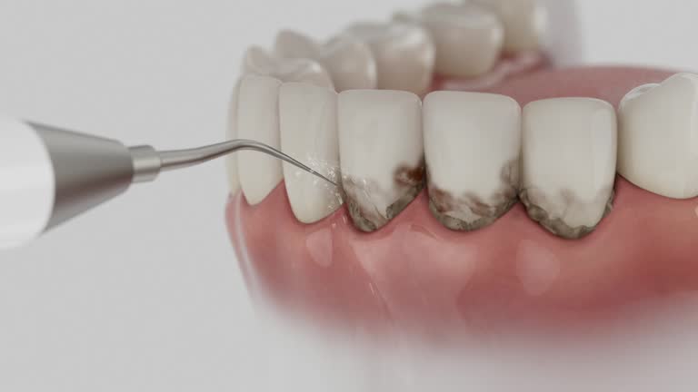 Reliable Dental Implants contractor in Garrison, TX by Smile Center Dentistry